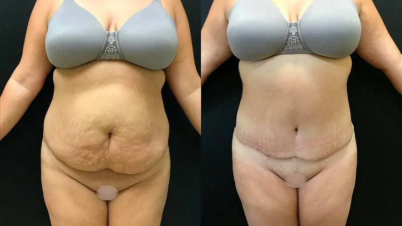 Tummy Tuck before and after — Front view