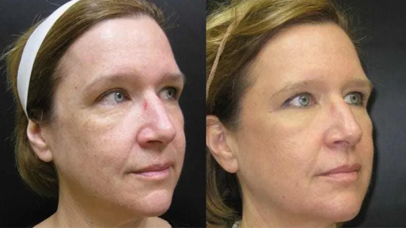Ultherapy before and after — Angled view