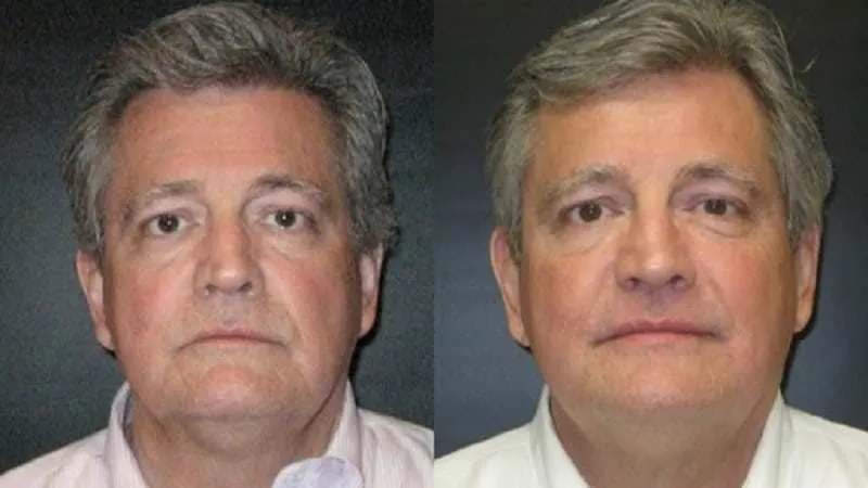 Ultherapy before and after — Front view