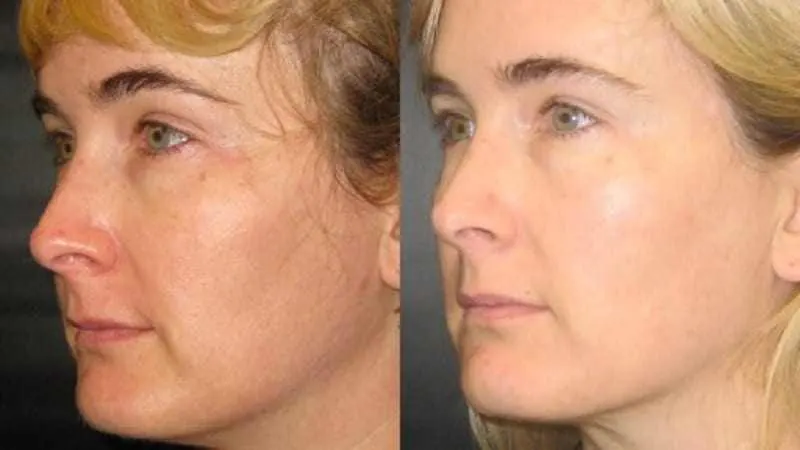 Ultherapy before and after — Angled view