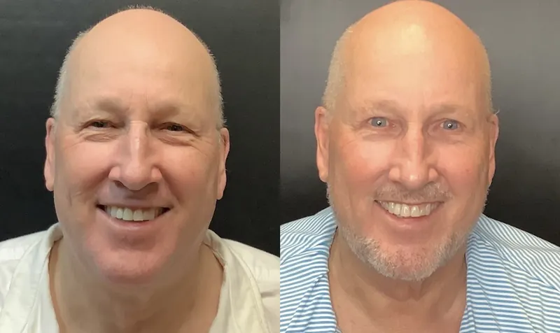 UltraClear Laser Coring before and after - frontal view