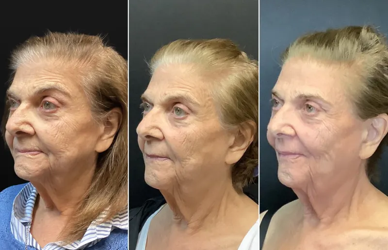 UltraClear 3D MIRACL before and after - oblique view