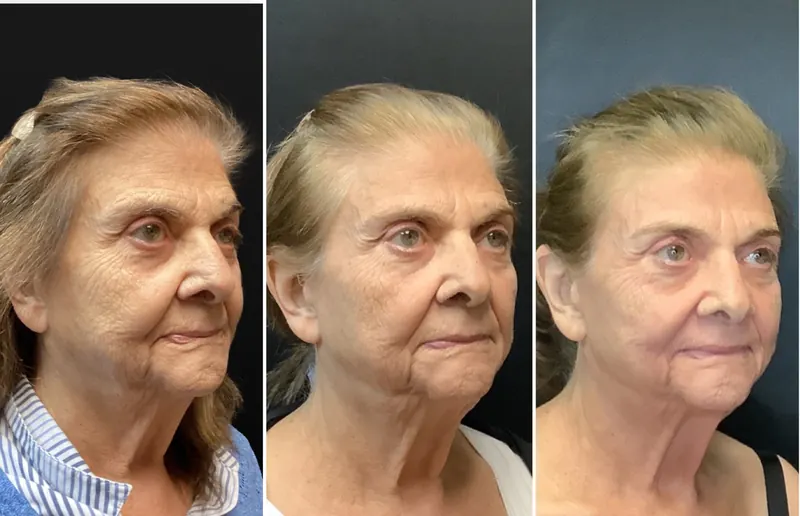 UltraClear 3D MIRACL before and after - oblique view