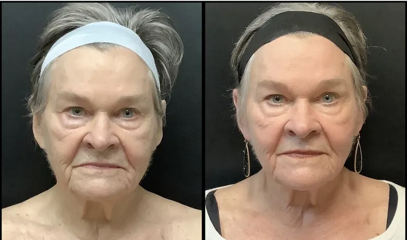 UltraClear Laser Coring before and after - frontal view