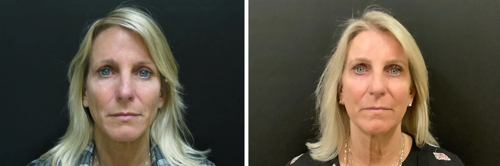 Botox before and after result, photographed straight on, Halfway through a filler session, and 14 years apart