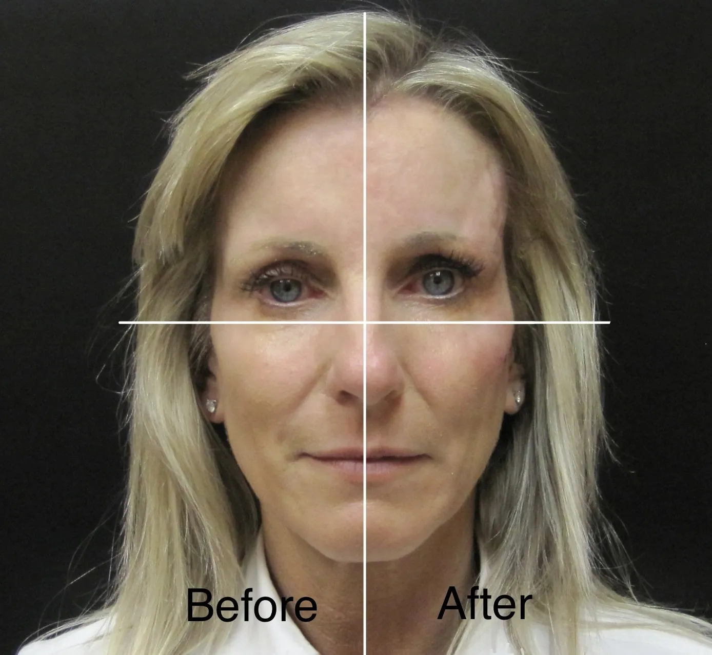Botox before and after result, photographed straight on, Halfway through a filler session, and 14 years apart