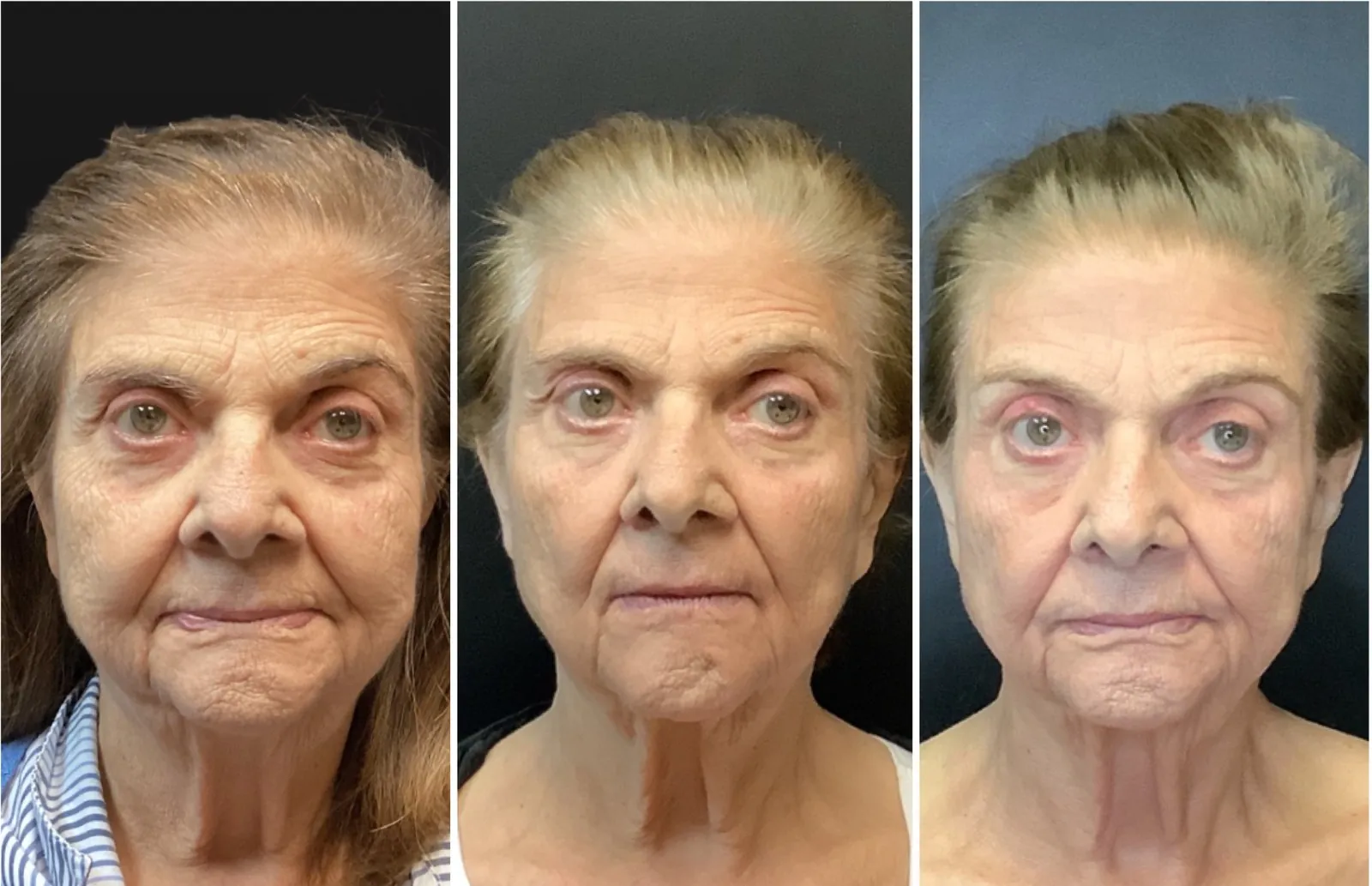 UltraClear Laser Coring and UltraClear 3D MIRACL before and after result, photographed straight on, 2 months after each of two sessions