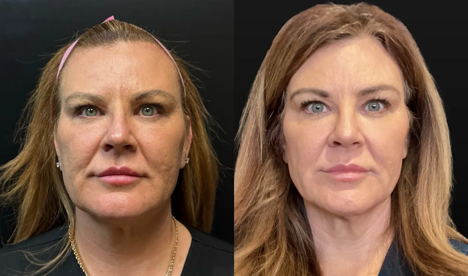 UltraClear Laser Coring and UltraClear 3D MIRACL before and after result, photographed straight on, 6 months after treatment